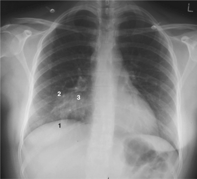4: Opacités pulmonaires | Medicine Key