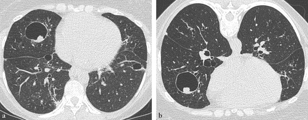 9 Pneumopathies Infiltratives Diffuses Medicine Key