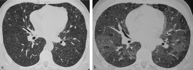 9 Pneumopathies Infiltratives Diffuses Medicine Key