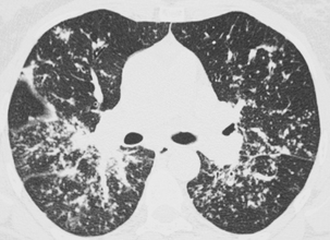 9 Pneumopathies Infiltratives Diffuses Medicine Key