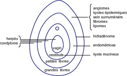 11: Pathologie de la vulve et du vagin | Medicine Key