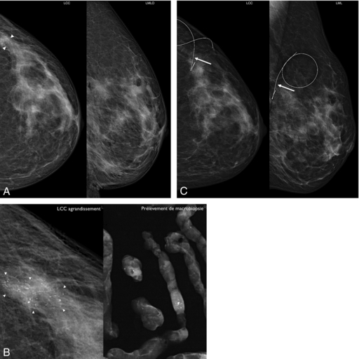 5: Cancers du sein : diagnostic, traitement et aspect post ...
