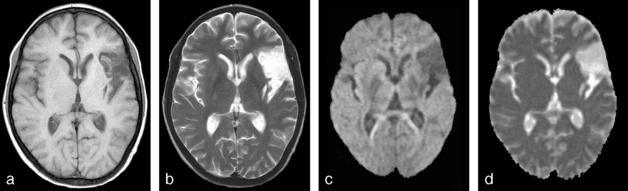 15: Imagerie De Diffusion, De Perfusion Et IRM Fonctionnelle | Medicine Key