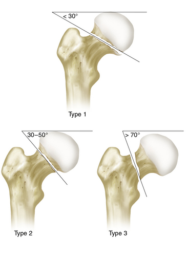 6: Fractures Du Col Du Fémur : Réduction Et Ostéosynthèse | Medicine Key